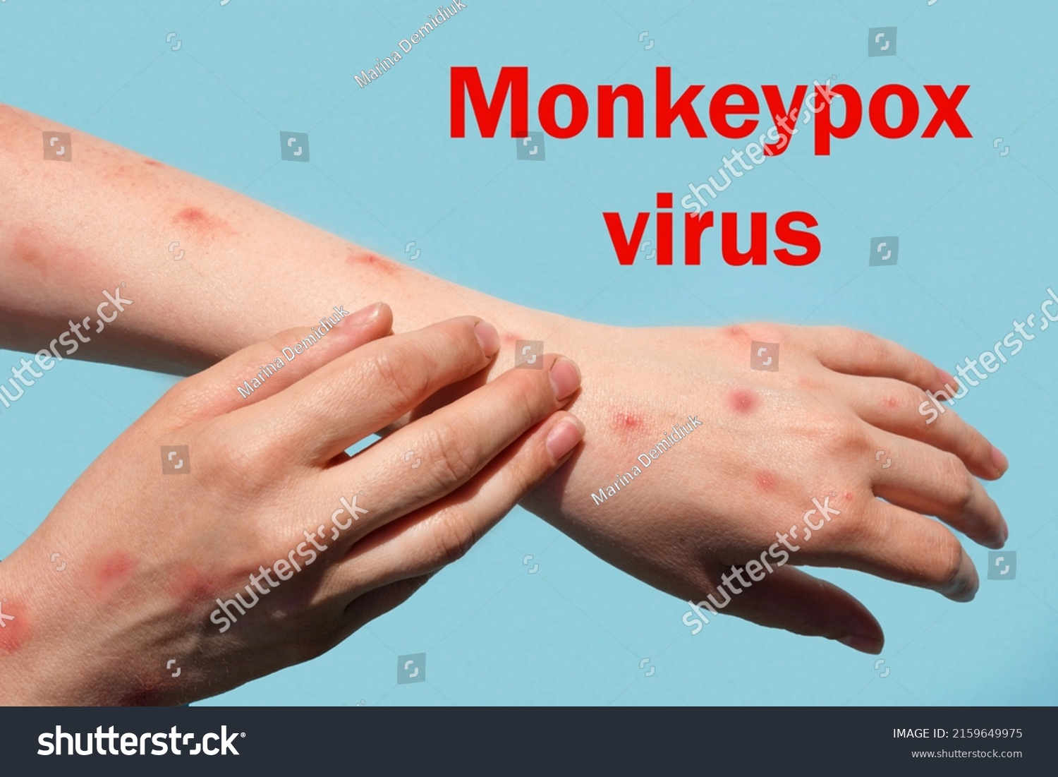 Monkeypox new disease dangerous over the world. Patient with Monkey Pox. Painful rash, red spots blisters on the hand. Close up rash, human hands with Health problem. The word Monkeypox virus. #2159649975