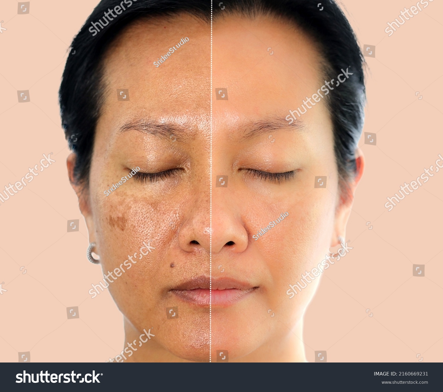 Retouched image before and after spot melasma pigmentation facial treatment on middle age asian woman face. Skincare and health problem concept.  #2160669231
