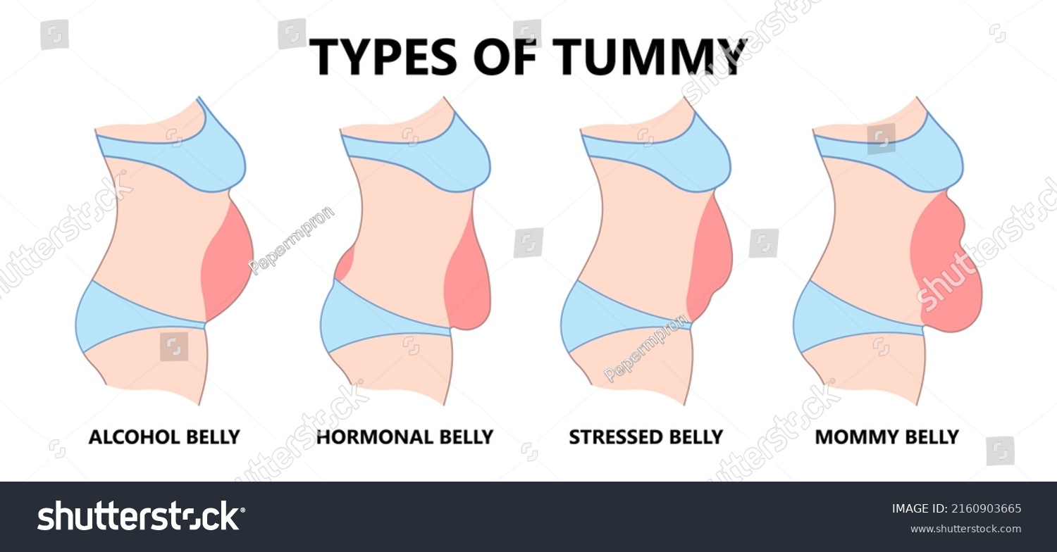 Diastasis Recti six pack separation belly rectus Linea alba abdominal surgical Tummy Tuck skin fat loss c section Ovary Over consuming Bloated Stressed Out childbirth #2160903665