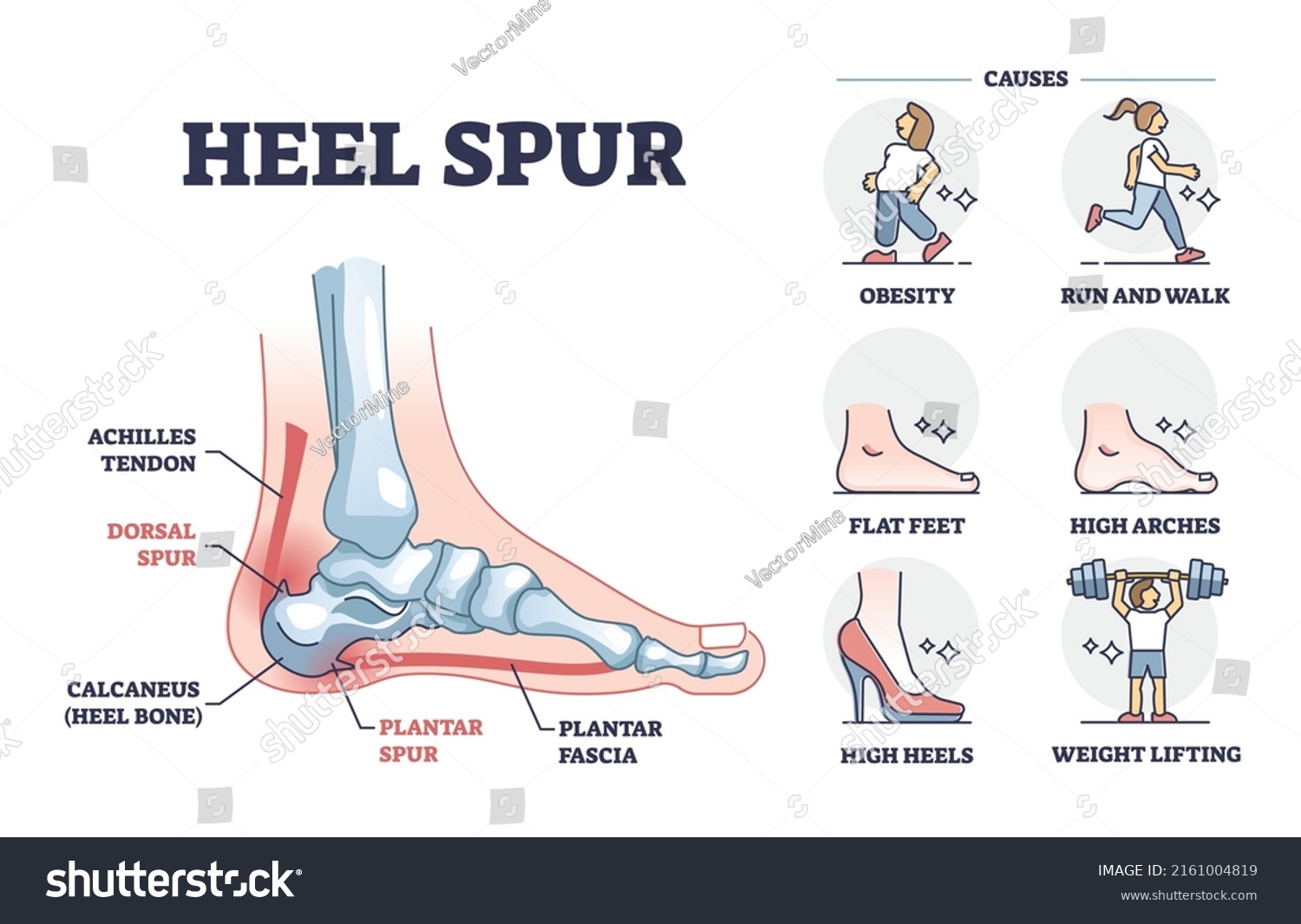 Heel spur problem or calcaneal bone condition causing pain in feet outline diagram. Labeled educational medical scheme with achilles tendon and plantar fascia inflammation anatomy vector illustration. #2161004819
