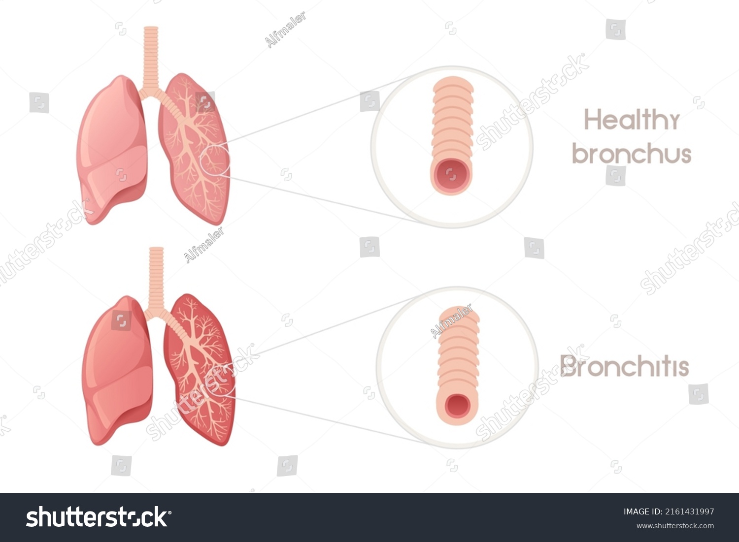 Human bronchi with bronchitis cartoon design - Royalty Free Stock ...