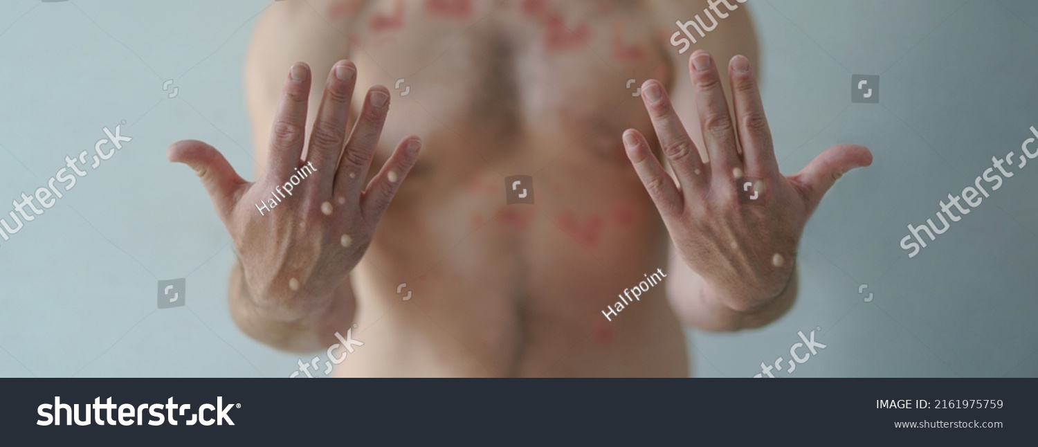 Male hands affected by blistering rash because of monkeypox or other viral infection on wide background #2161975759