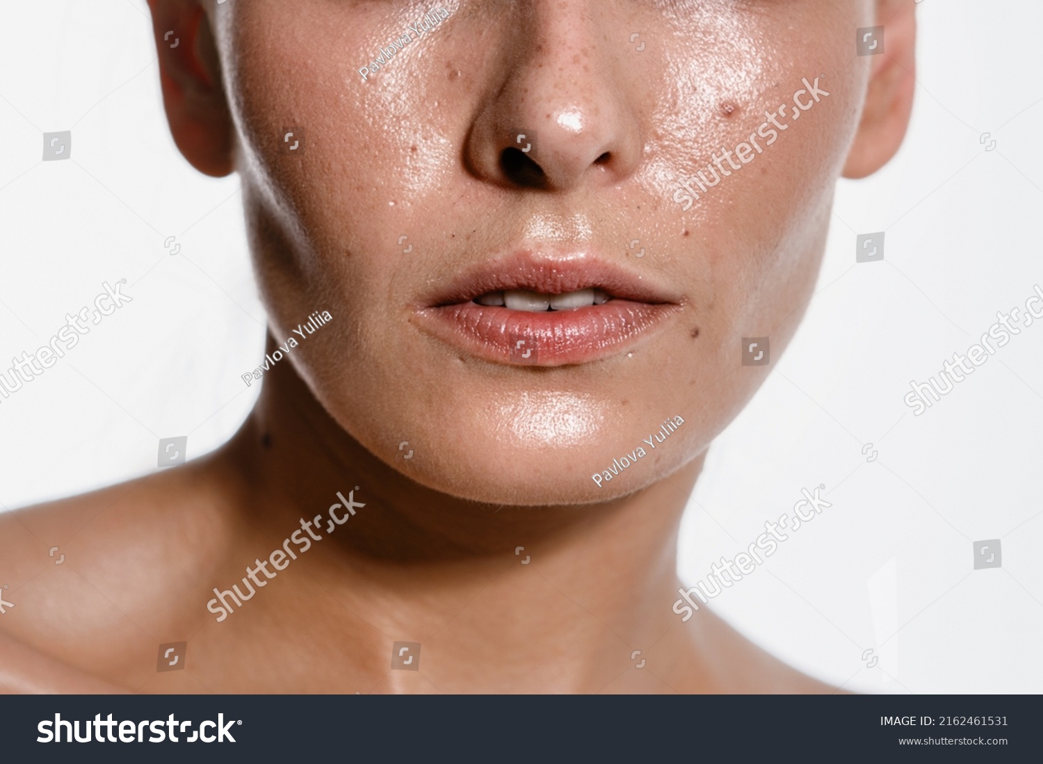 close-up girl with sweaty skin on her face and excessive oily sheen, excessive sweating, hyperhidrosis disease #2162461531