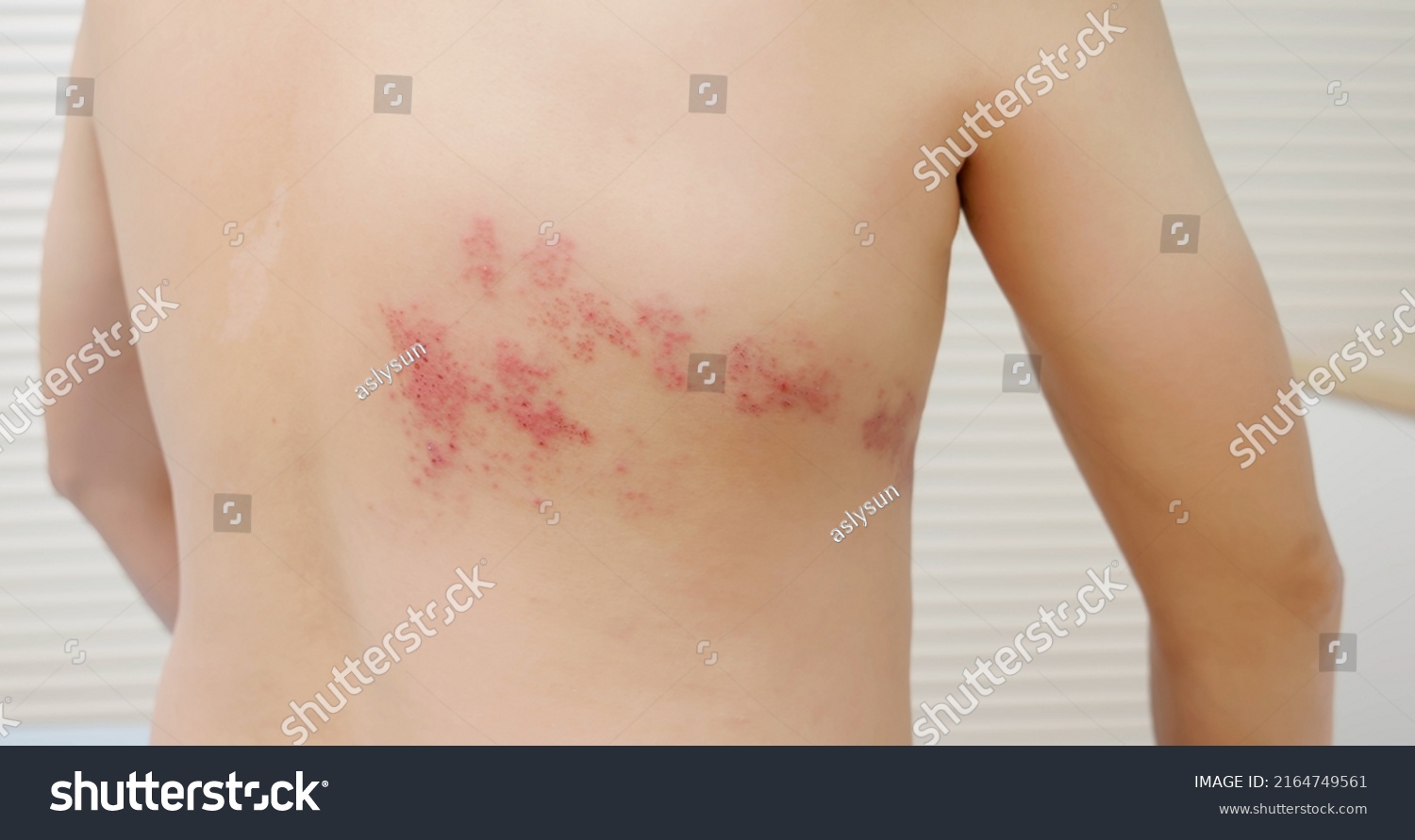 man with shingles disease on skin and he feel very painful #2164749561