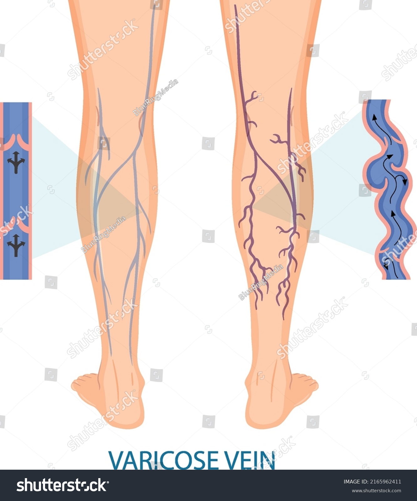 Human legs with varicose vein illustration #2165962411