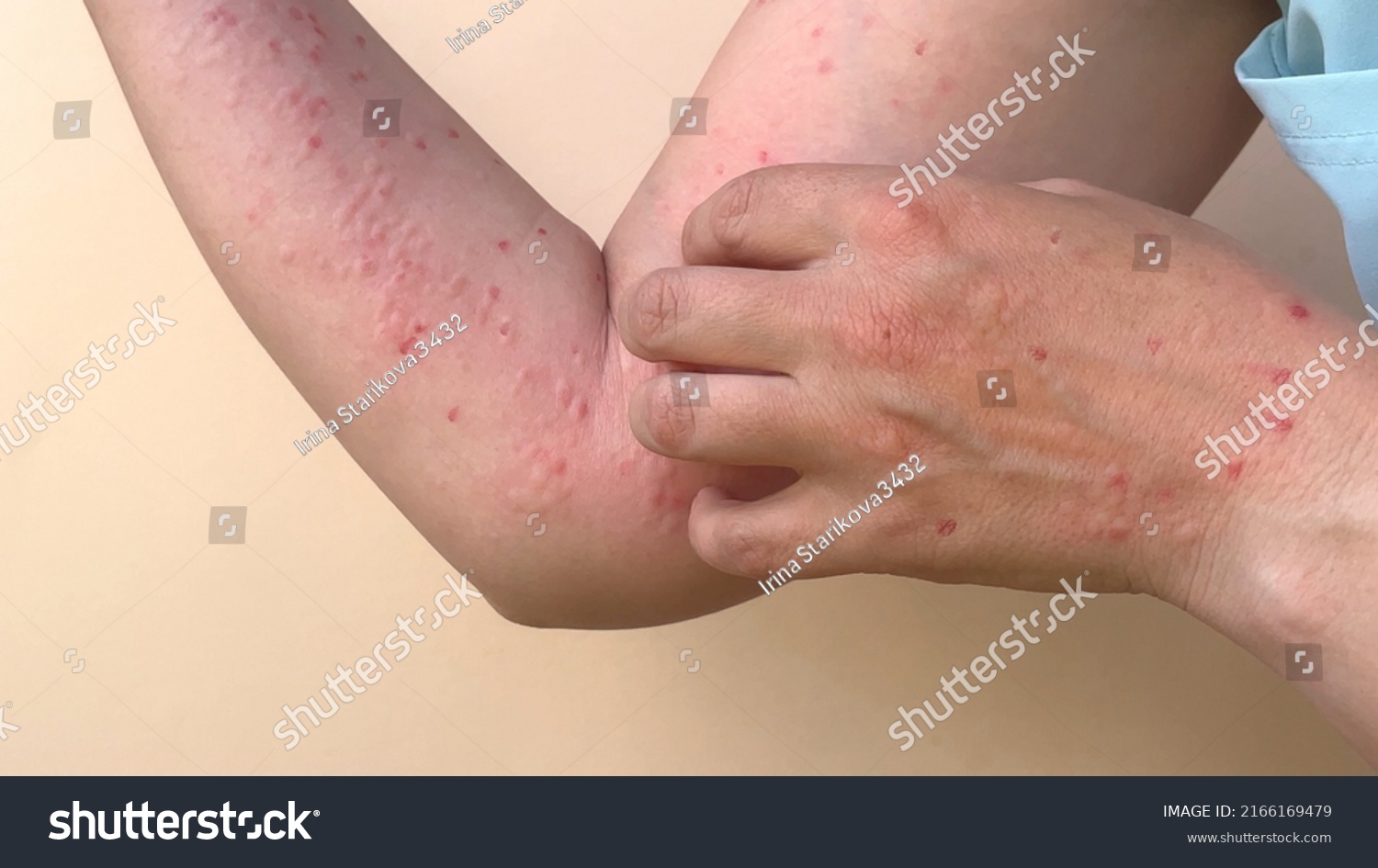 Monkey pox virus, a new world problem of modern humanity. Banner with hands of a sick person with pimples and blisters. Smallpox vaccine. #2166169479