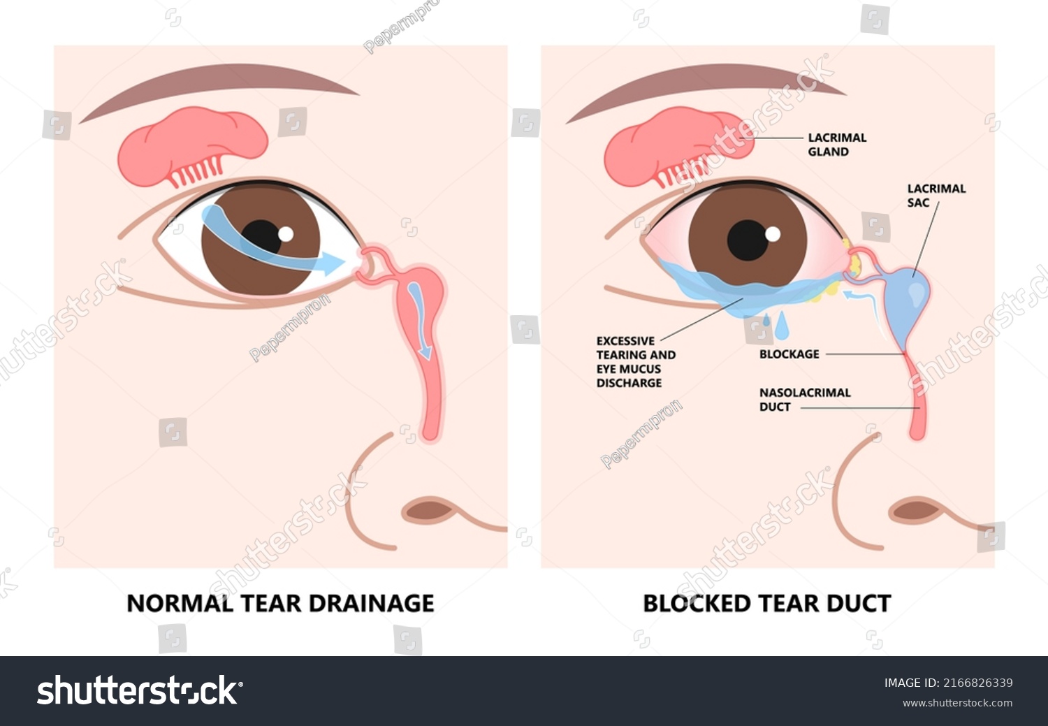 Blocked tear duct eye sinus toddler red dry Royalty Free Stock Vector