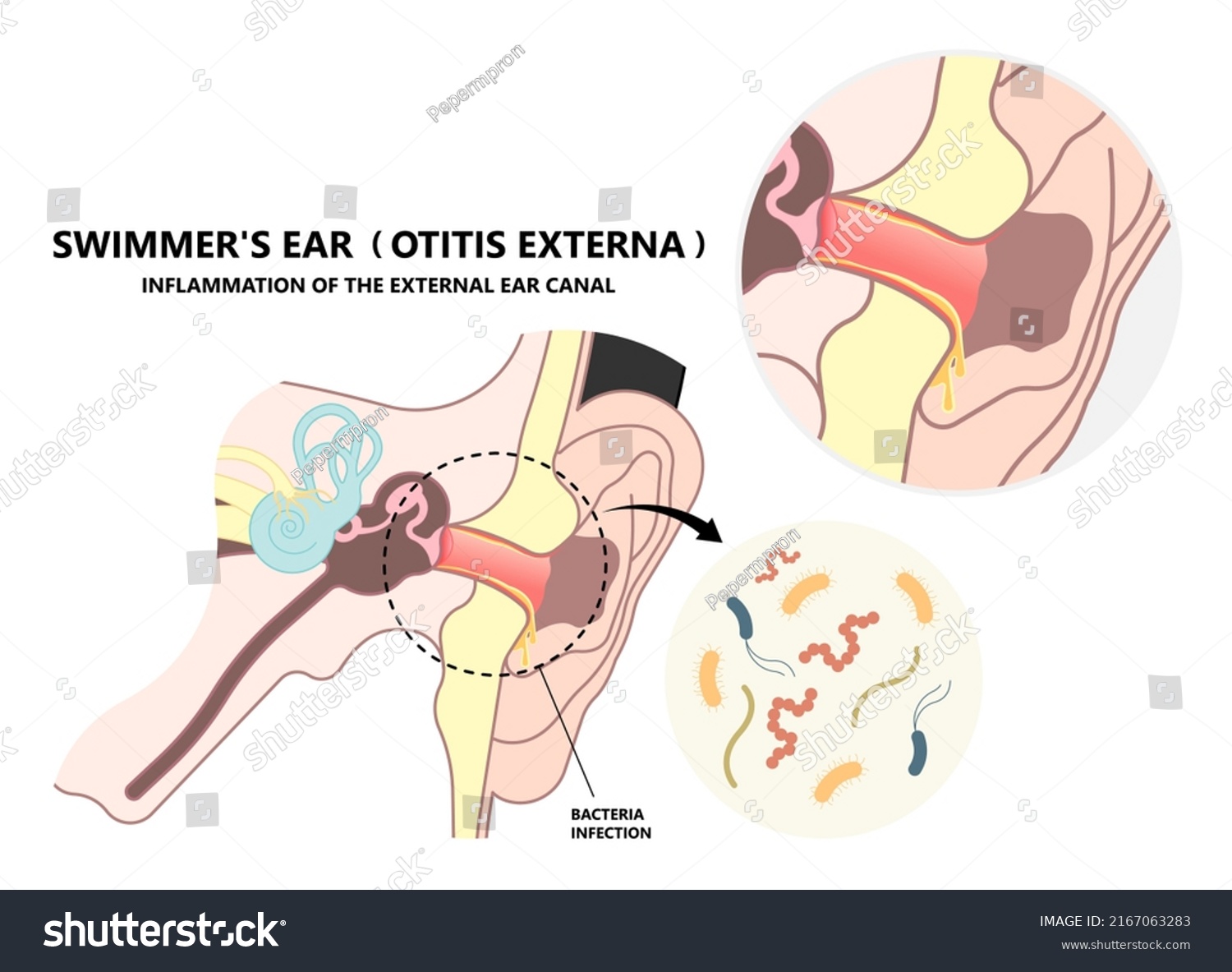 Acute Otitis Externa Inner Swimmer's Ear Canal - Royalty Free Stock ...