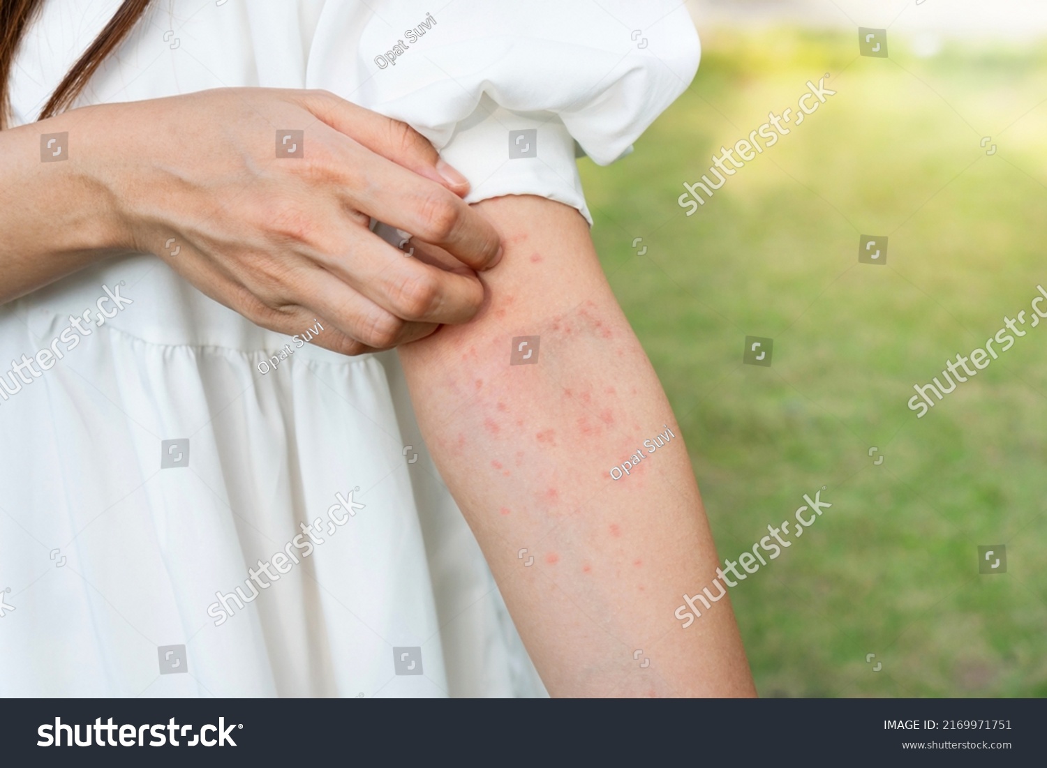 Closeup of woman hand scratching her skin itchy. Allergic rash dermatitis eczema skin, insect, food allergy, health care concept #2169971751