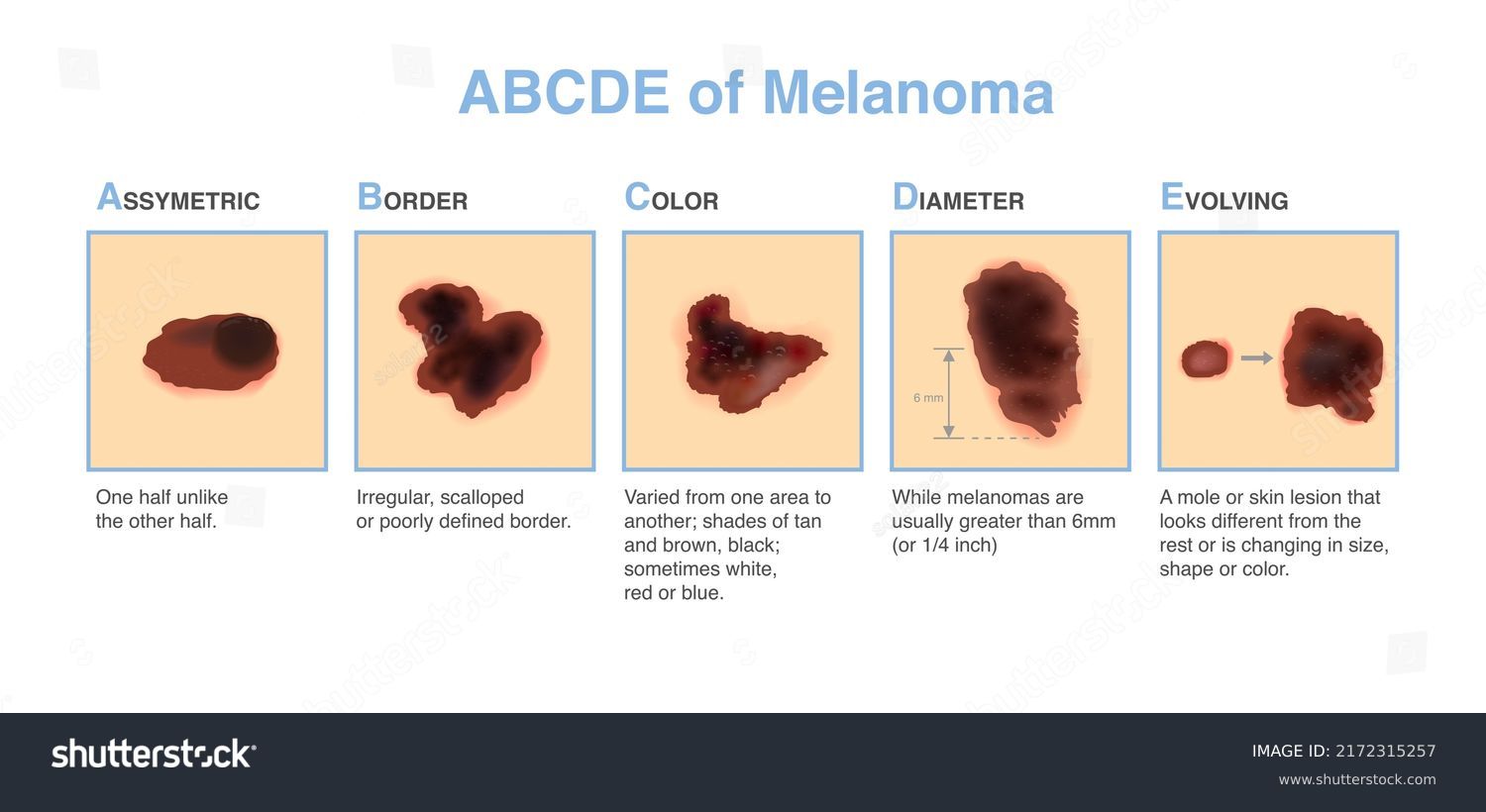 Different characteristics of skin damage. ABCDE - Royalty Free Stock ...