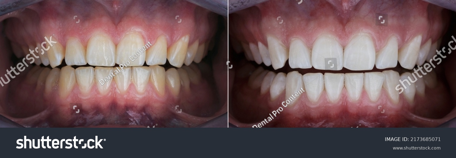 dental photo comparison before and after teeth whitening #2173685071