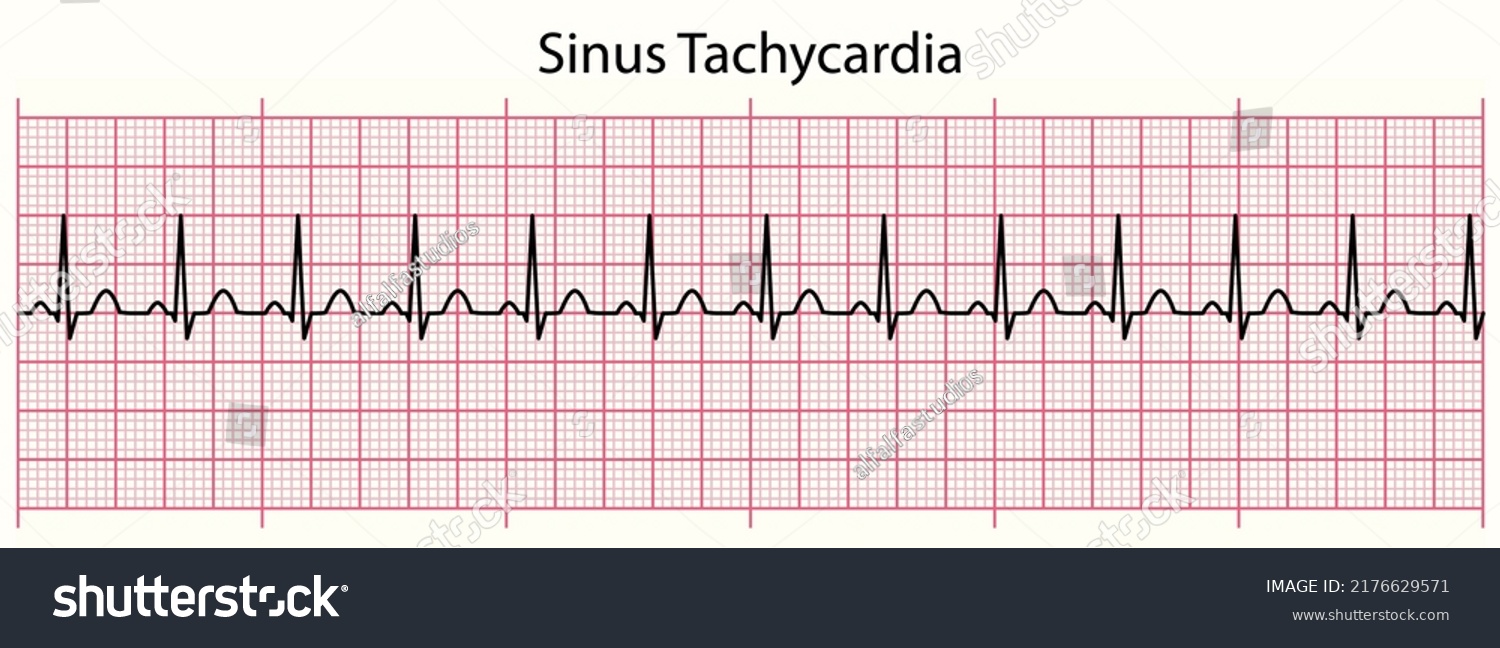 ECG line: Sinus Tachycardia in 6 second ECG - Royalty Free Stock Vector ...