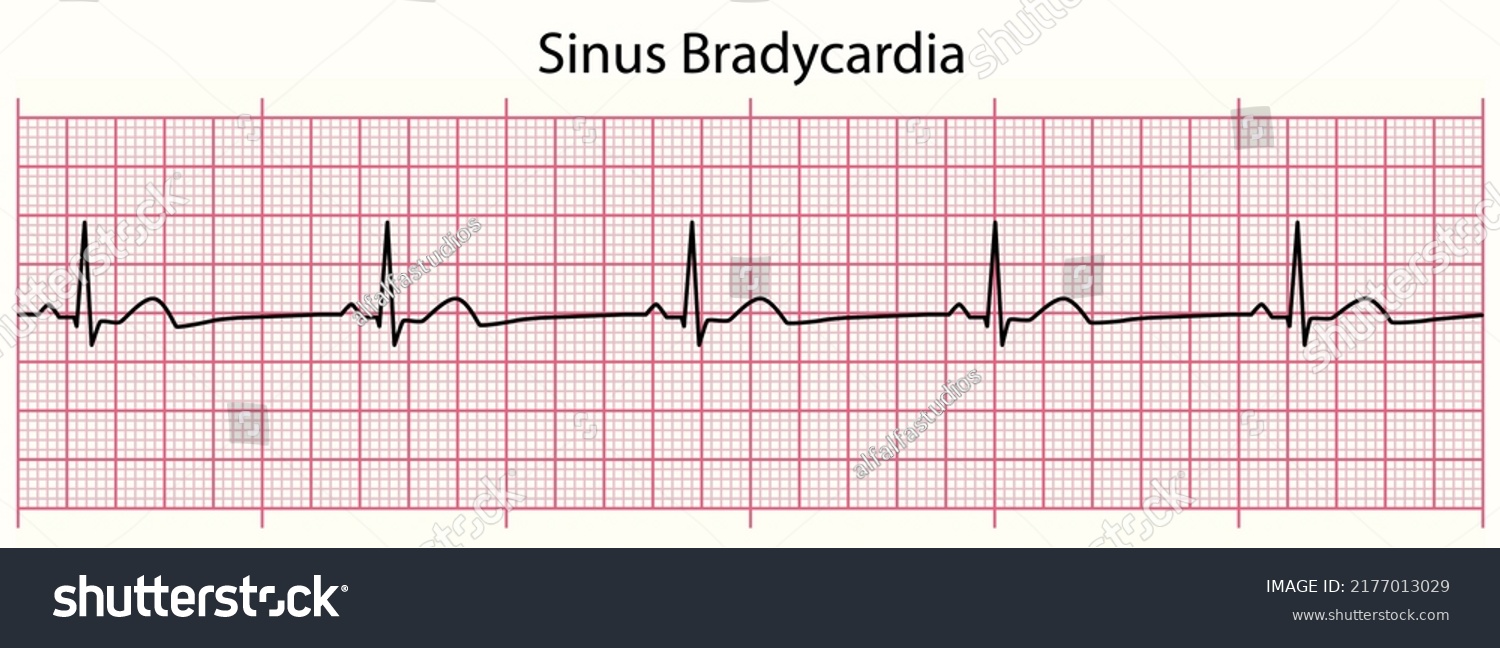 ECG line: Sinus Bradycardia in 6 second ECG paper line #2177013029