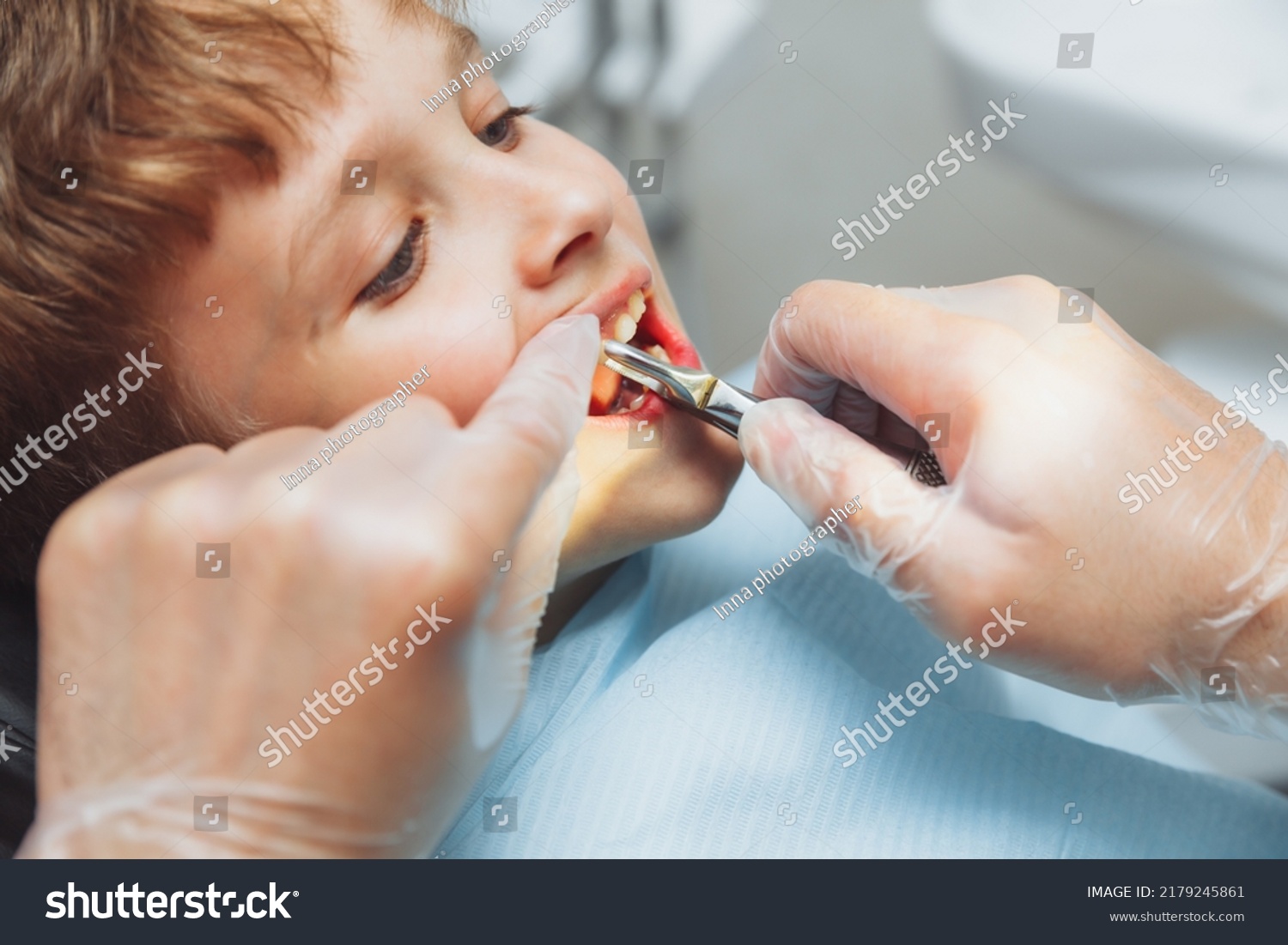 Portrait of a child patient and the hands of a pediatric dentist with dental forceps, close-up. painless extraction of teeth. pediatric dentistry. #2179245861
