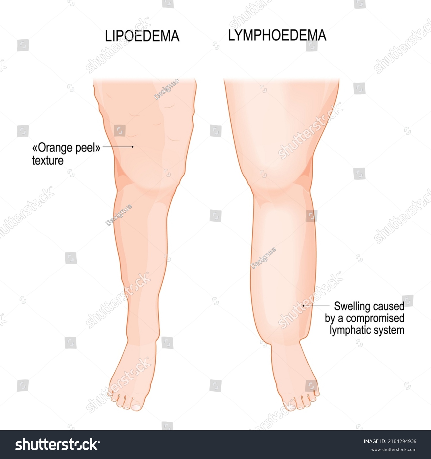 Lymphedema And Lipoedema Comparison And Royalty Free Stock Vector 2184294939