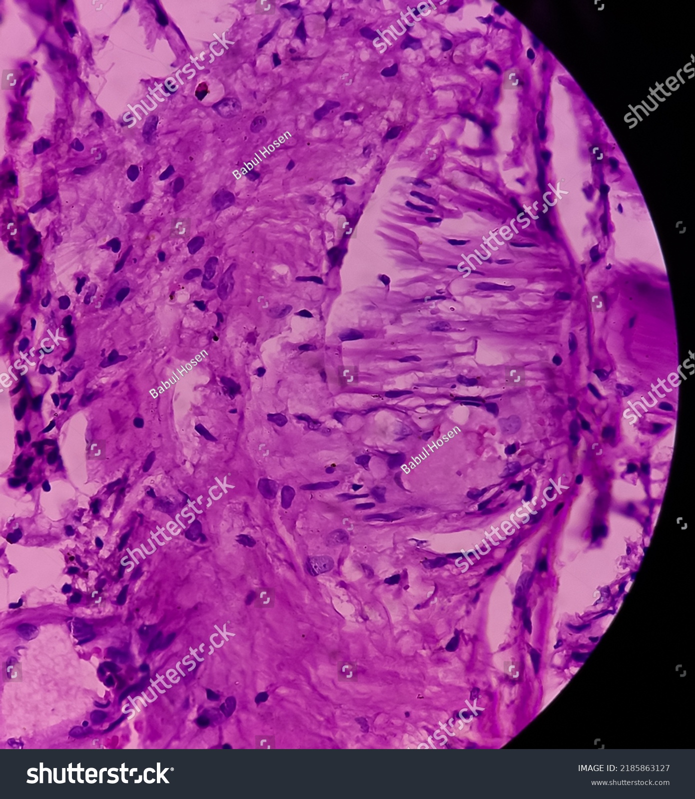 Dermoid Cyst Mature Cystic Teratoma Show Skin Royalty Free Stock