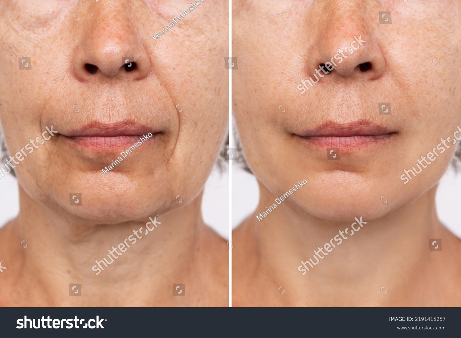 Lower part of face and neck of an elderly woman with signs of skin aging before after facelift, plastic surgery. Age-related changes, flabby sagging skin, wrinkles, creases, puffiness. Rejuvenation #2191415257