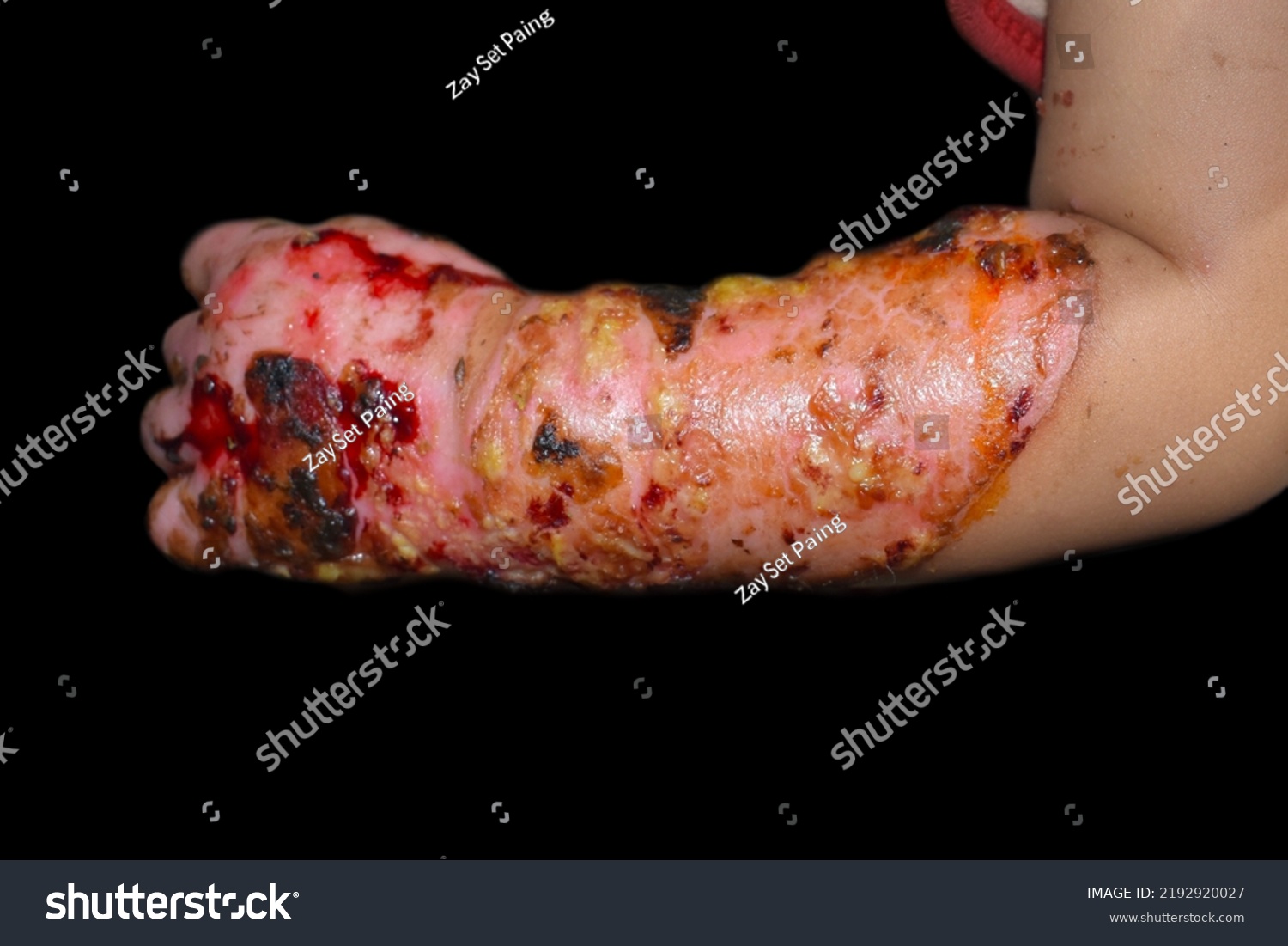 Burn wound surrounded by scabs and exsudates in hand and forearm of Southeast Asian child. Closeup view. #2192920027