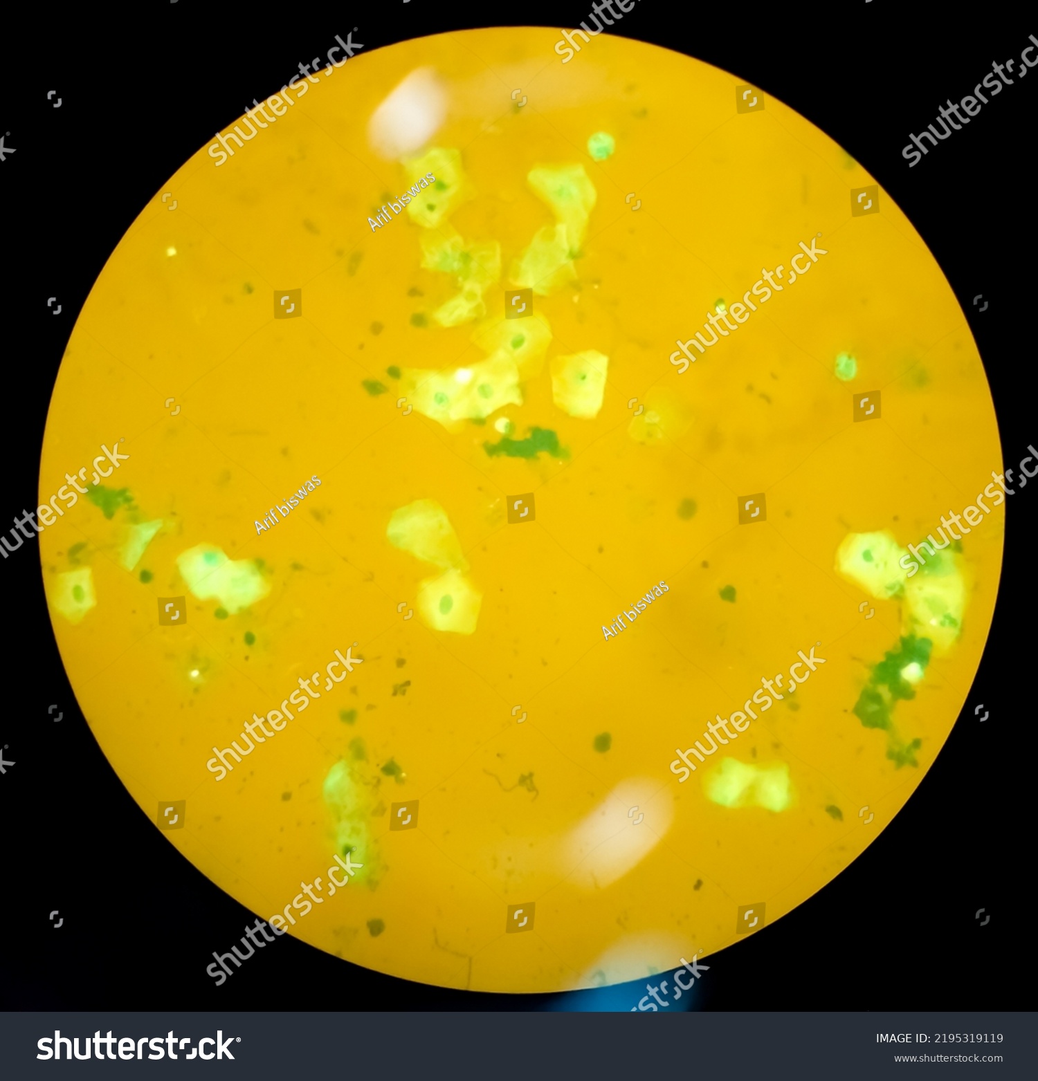 Sputum or phlegm smear AFB, auramine O and - Royalty Free Stock Photo ...