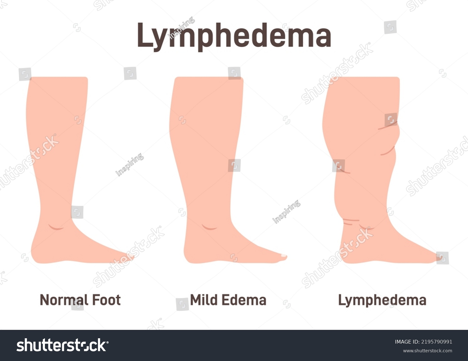 Lymphedema stages. Lymphatic system dysfunction - Royalty Free Stock ...