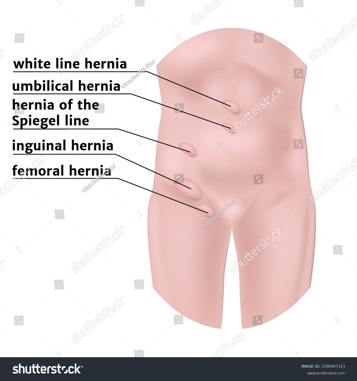 Types Of Hernias In The Abdominal Cavity With A Royalty Free Stock