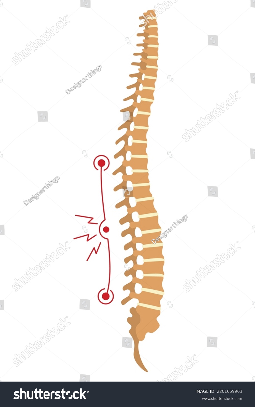 Spinal deformity. Symbol of spine curvatures or - Royalty Free Stock ...