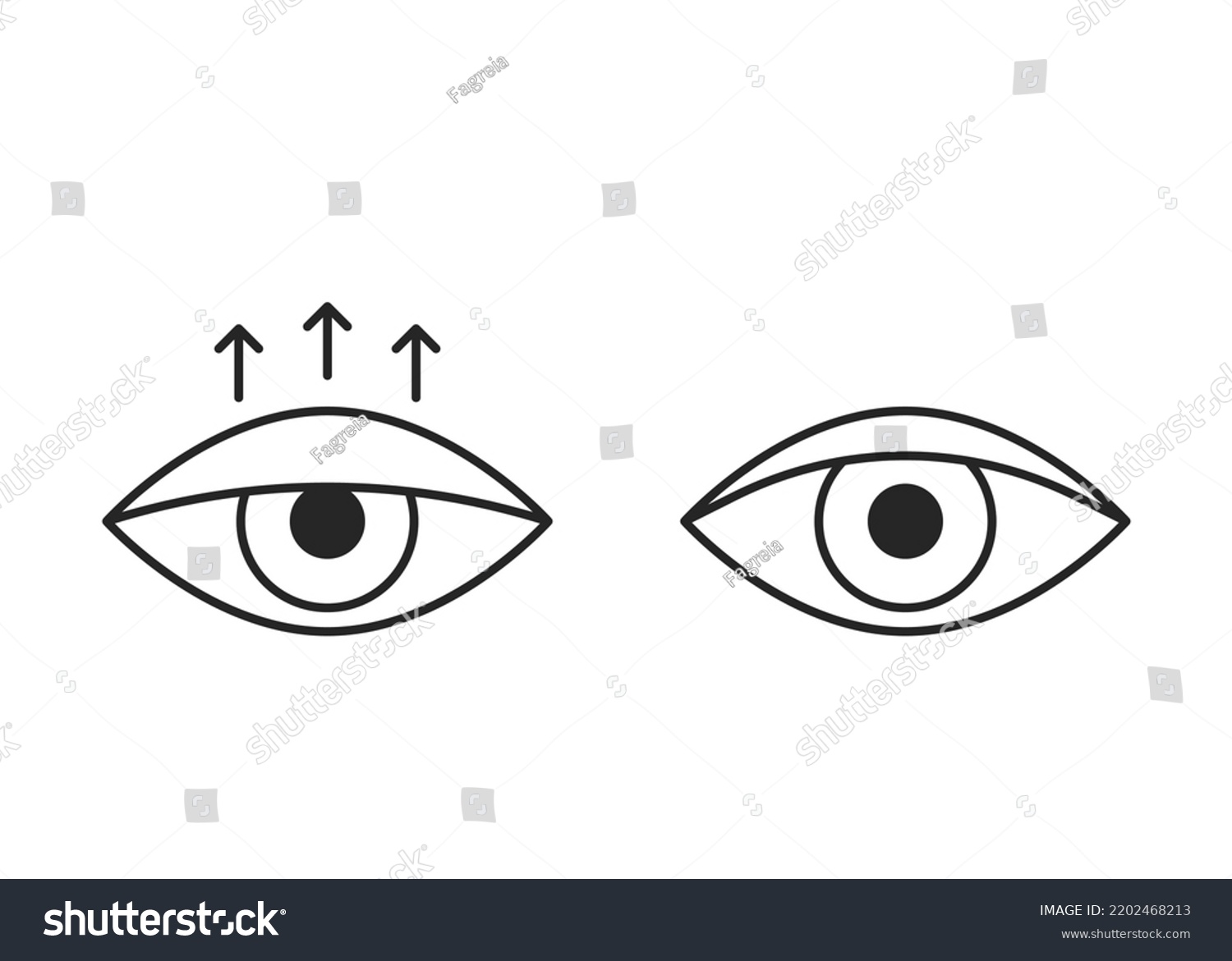 Comparison eye with down lid ptosis and healthy - Royalty Free Stock ...