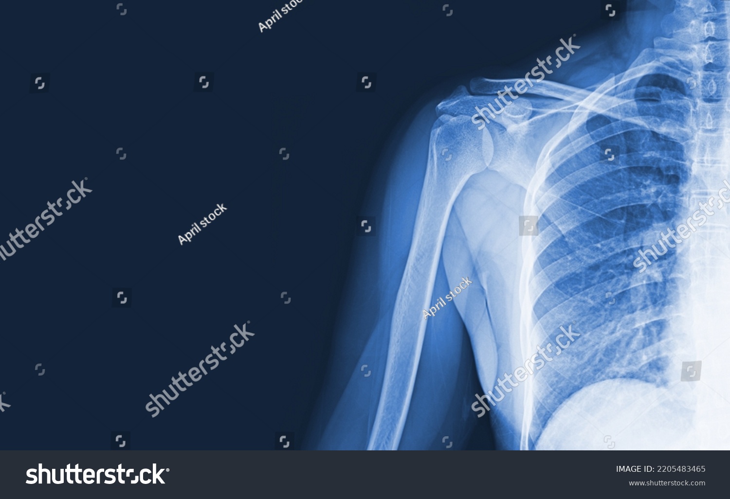 x-ray images of the shoulder joint to see injuries bones and tendons for a medical diagnosis.Medical image concept and copy space. #2205483465