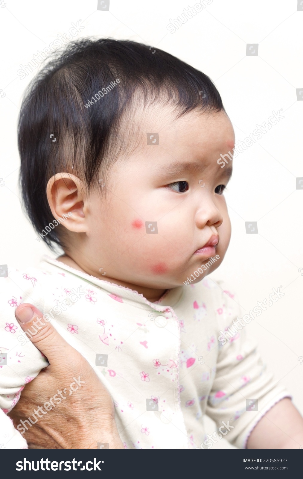 Baby S Face With Red Spots Due To Insect Bite Royalty Free Stock Photo 220585927 Avopix Com