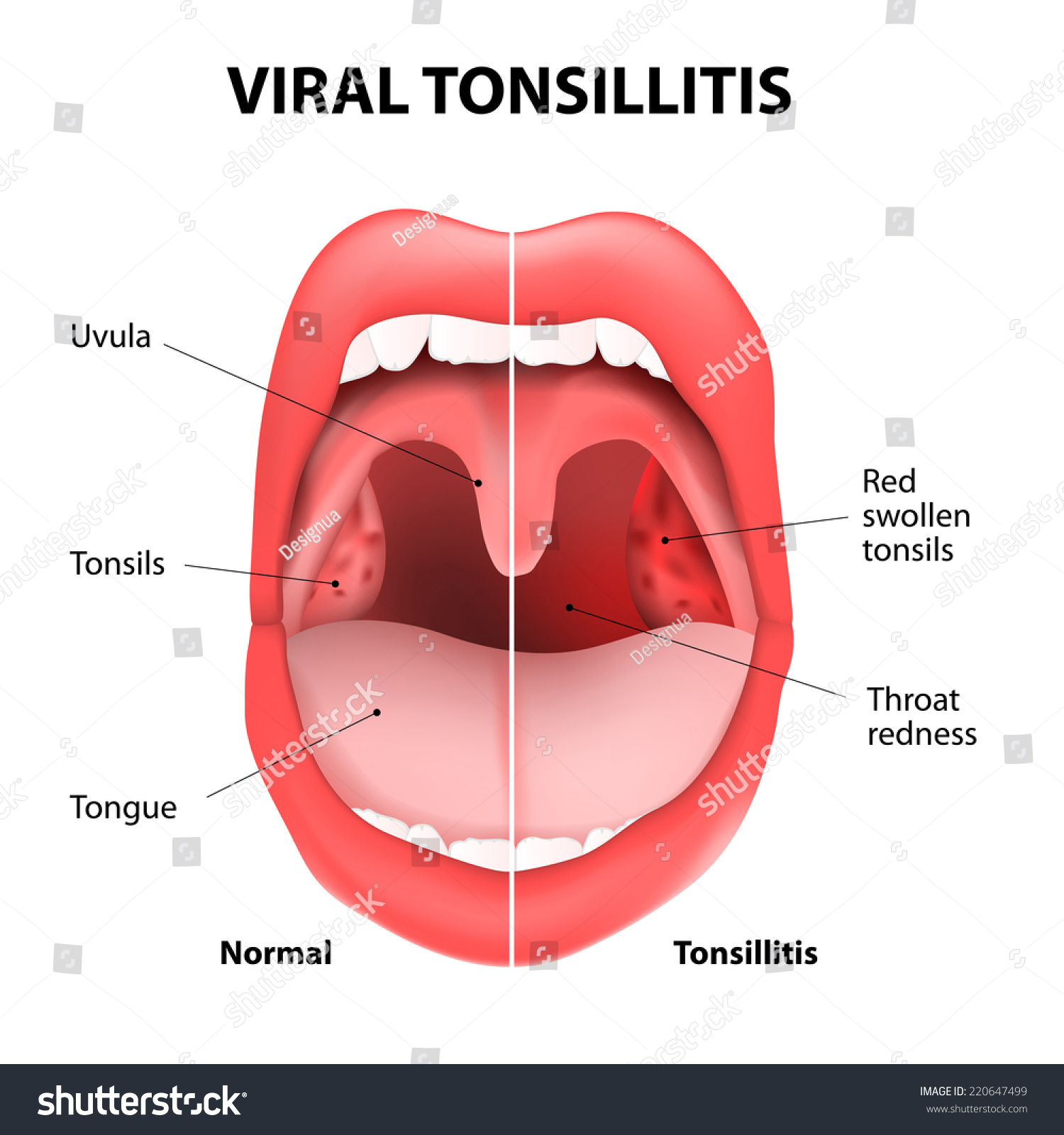 viral tonsillitis or upper respiratory tract - Royalty Free Stock ...