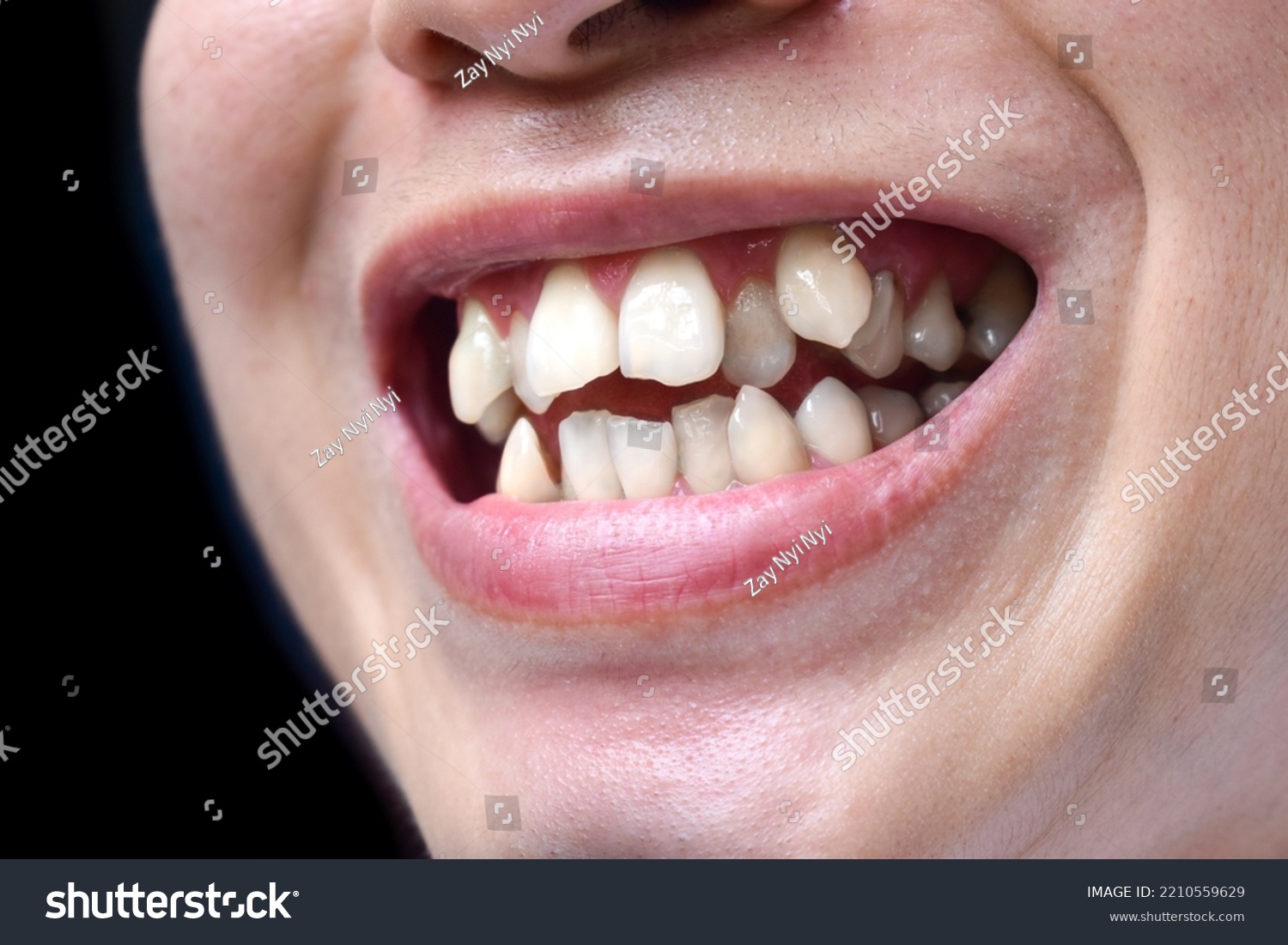 Stacked or overlapping white teeth of Asian man. Also called crowded teeth. #2210559629