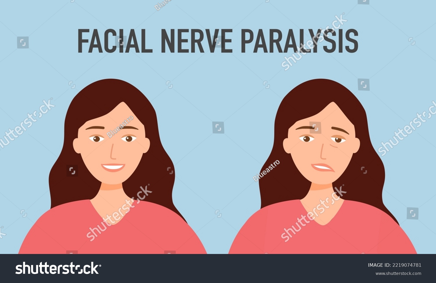 Facial nerve paralysis concept vector illustration. Face palsy. #2219074781