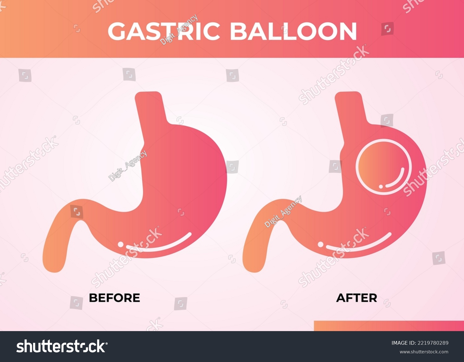 Stomach Endoscopy Gastric Balloon Inside A Royalty Free Stock Vector