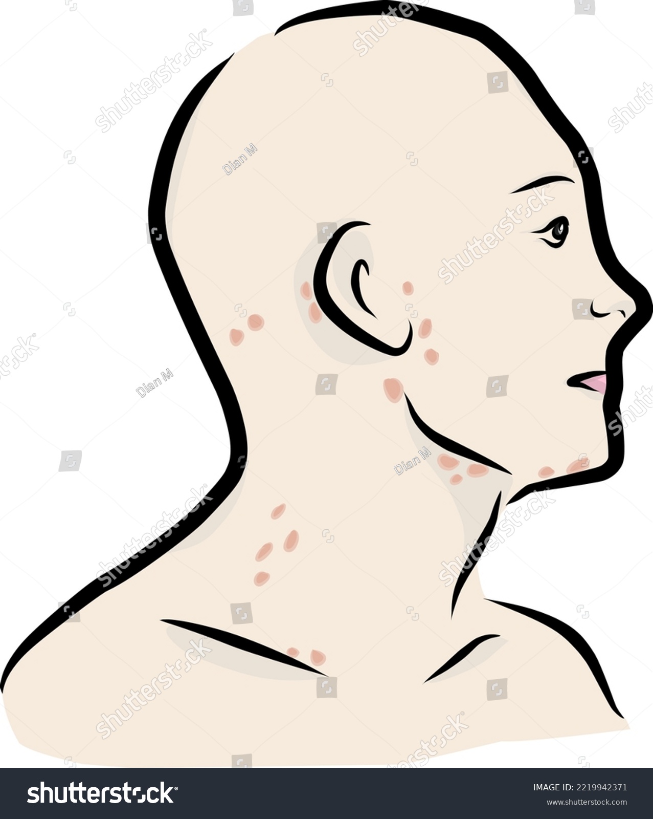 Skin Lesions On Human Neck Vector Art Anatomy Royalty Free Stock Vector 2219942371