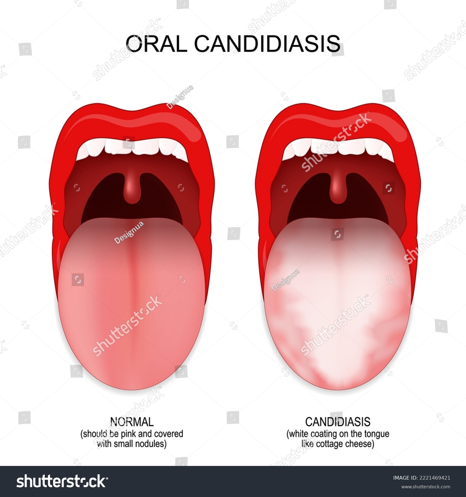 oral-candidiasis-difference-and-comparison-of-royalty-free-stock