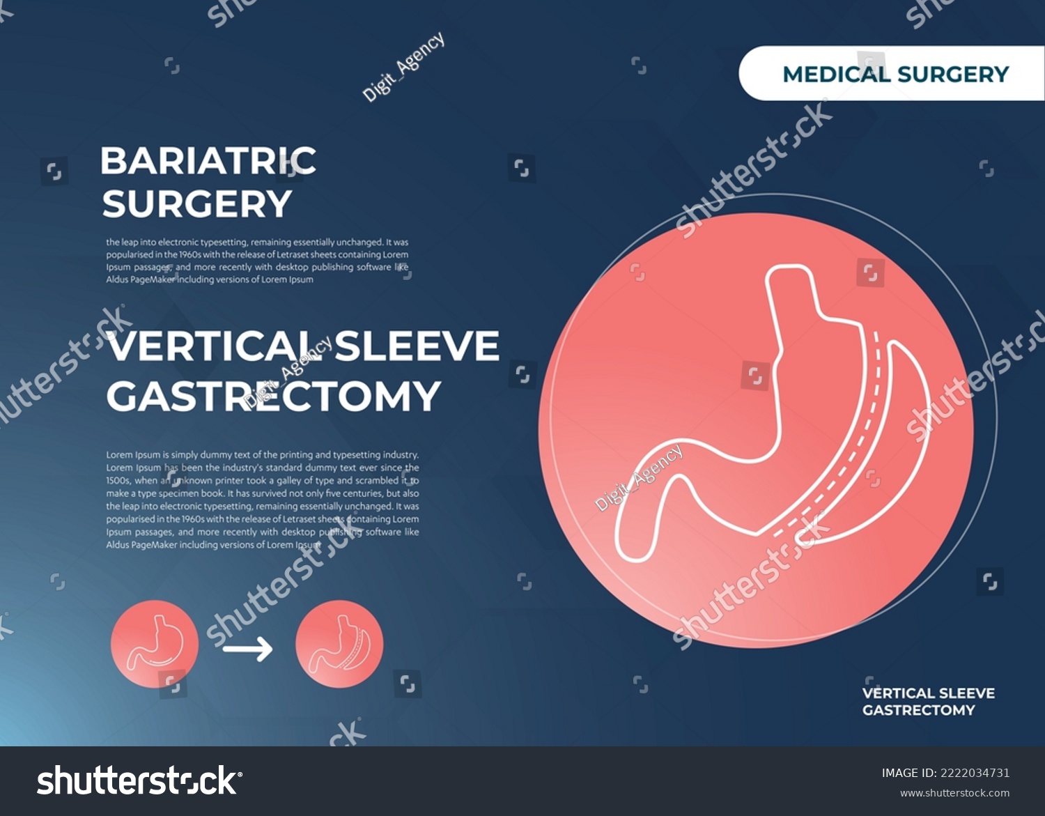 Laparoscopic Sleeve Gastrectomy, Vertical - Royalty Free Stock Vector ...