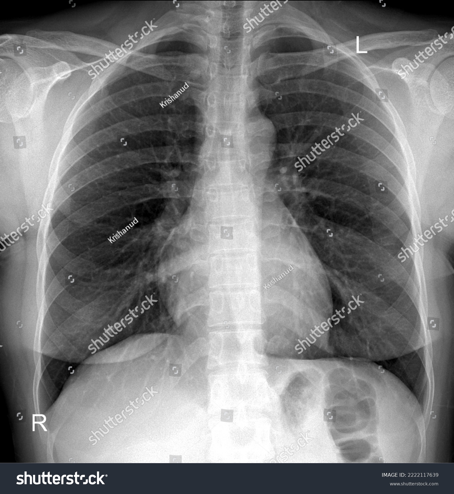 Chest x-Ray radiograph posteroanterior view - Royalty Free Stock Photo ...