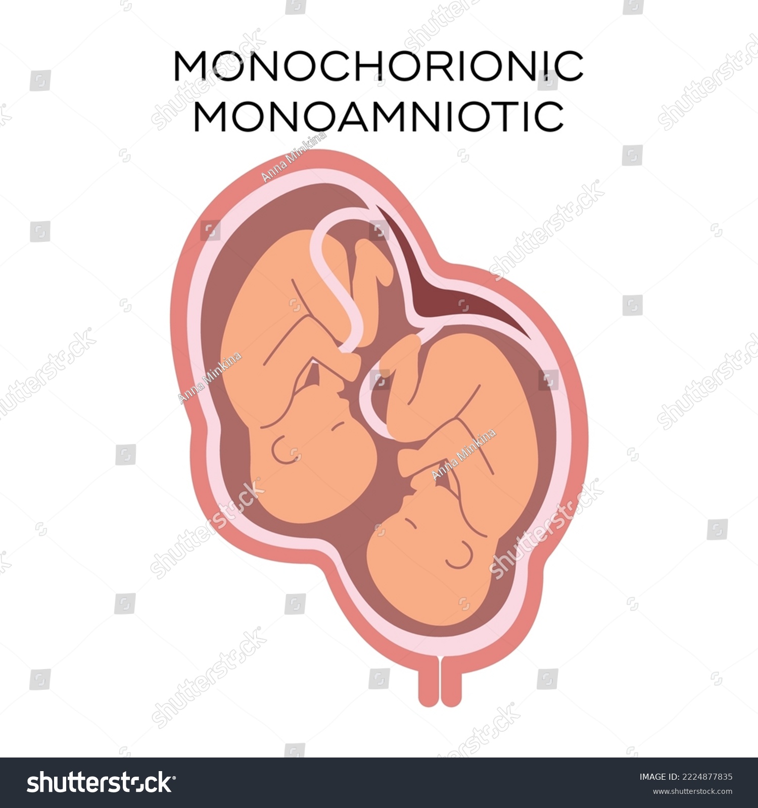 Monochorionic monoamniotic twins vector - Royalty Free Stock Vector ...