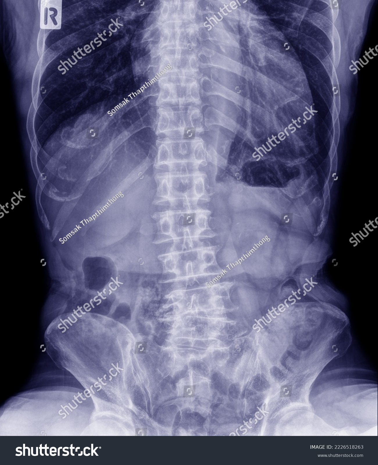 X-ray photograph of the spine in the Uplai position. #2226518263