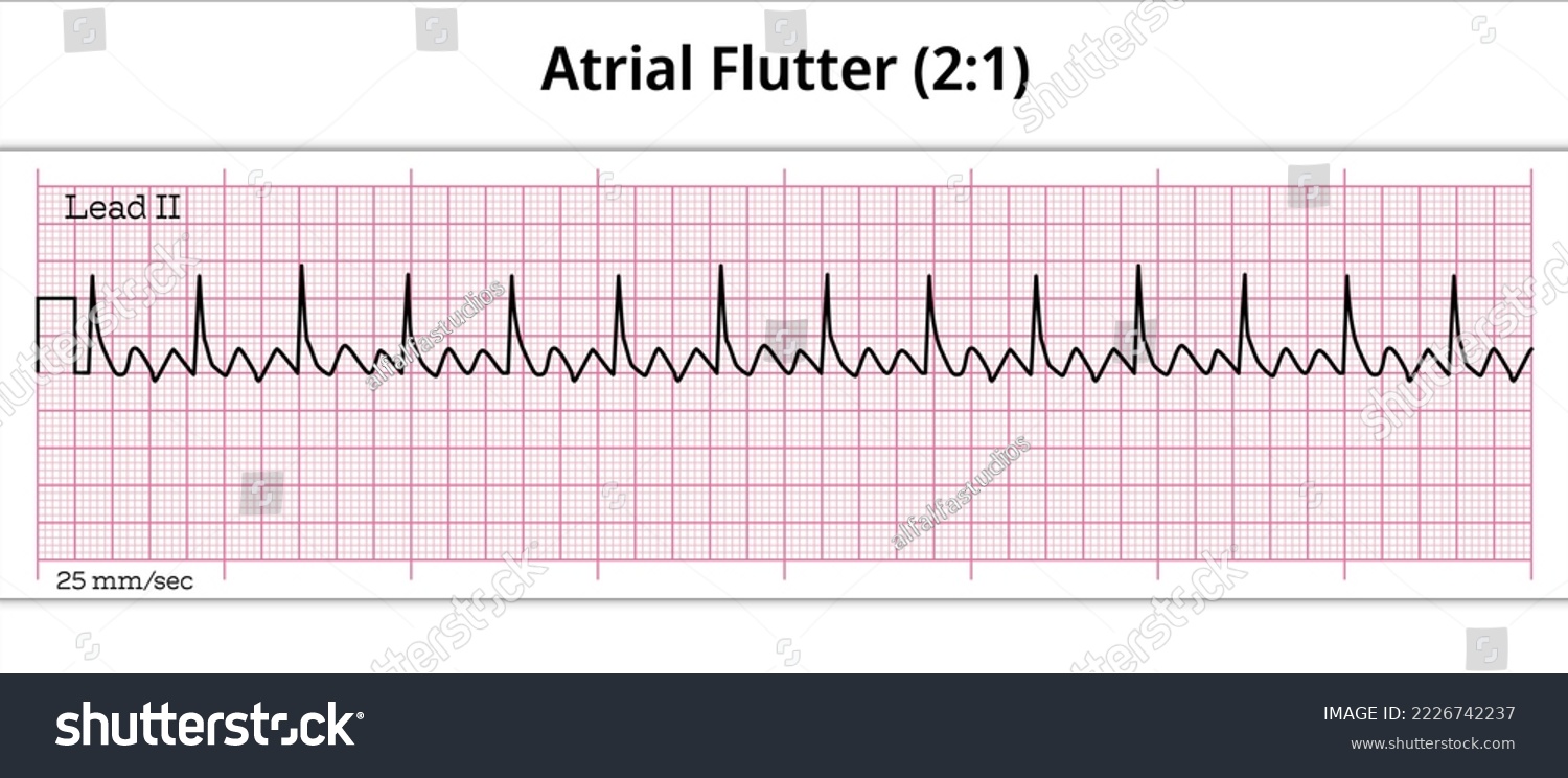 ECG Atrial Flutter (2:1)- 8 Second ECG Paper - Royalty Free Stock ...