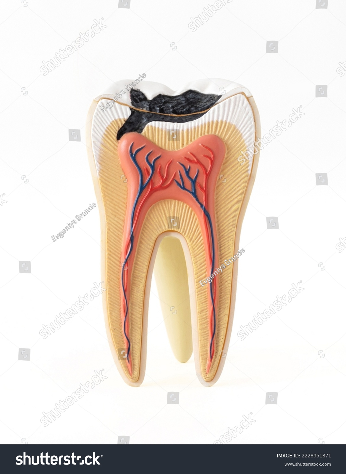 Isolated photo of internal tooth structure model with caries destruction on white background #2228951871