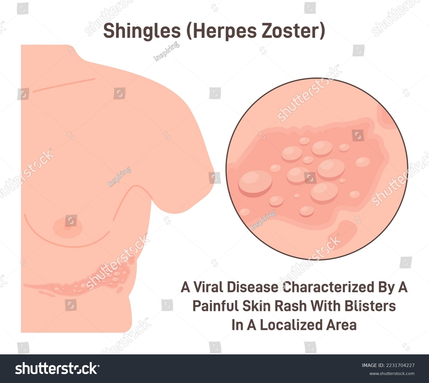 Shingles. Herpes zoster, viral disease with skin rush with stripe of blisters appearance. Flat vector illustration #2231704227