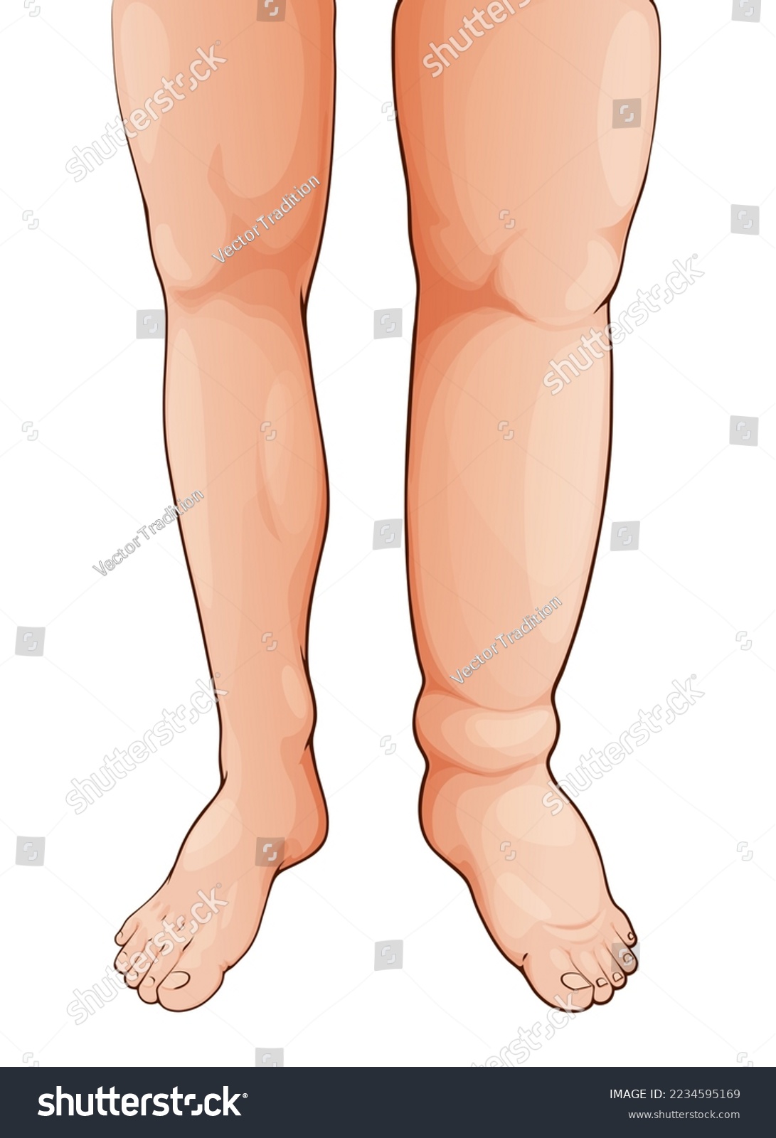 Edema Swollen Leg And Foot Lymphedema Oedema Royalty Free Stock