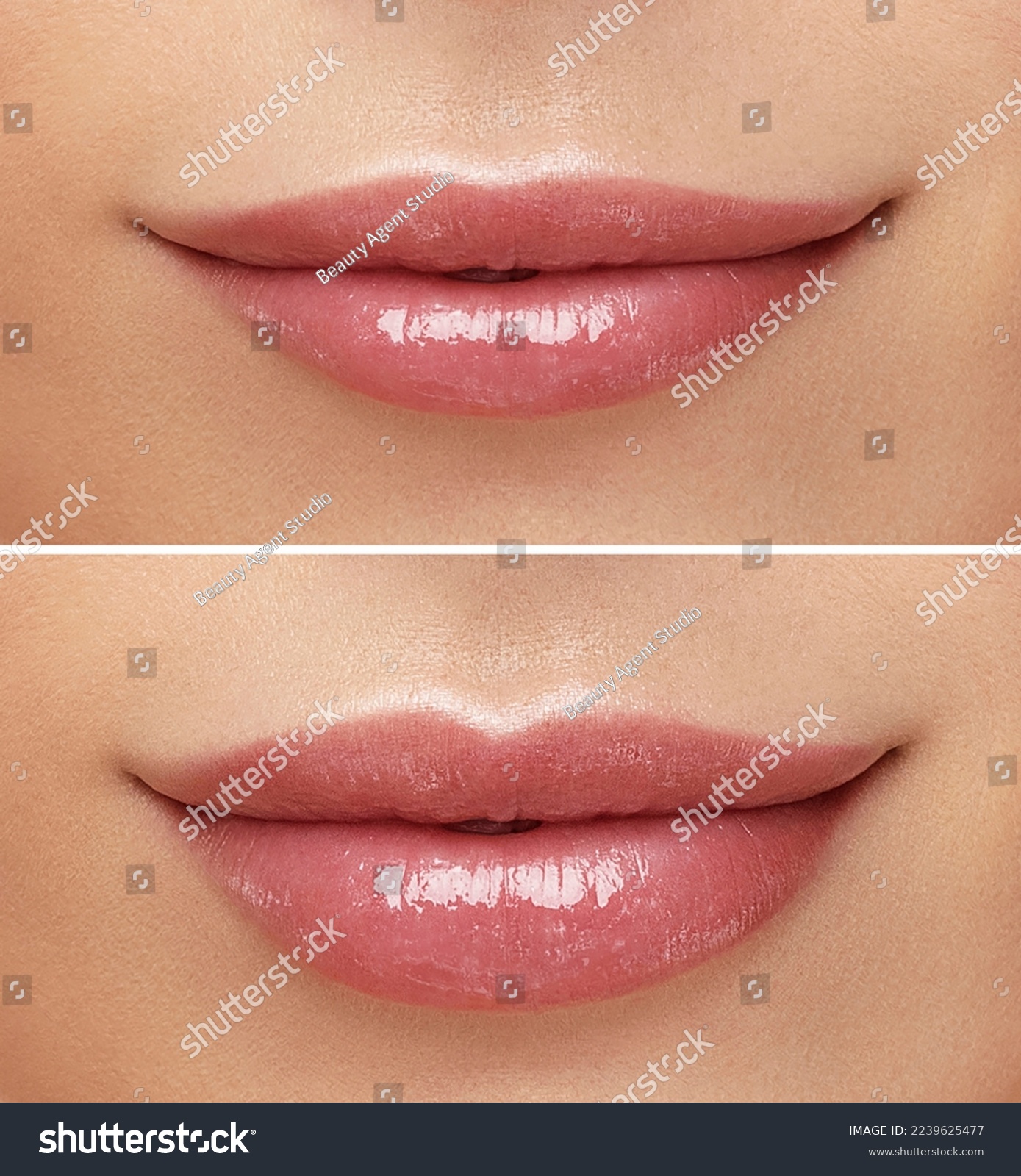 Women lips correction before and after comparison. Hyaluronic acid injection. Beauty lip treatment procedure.  #2239625477