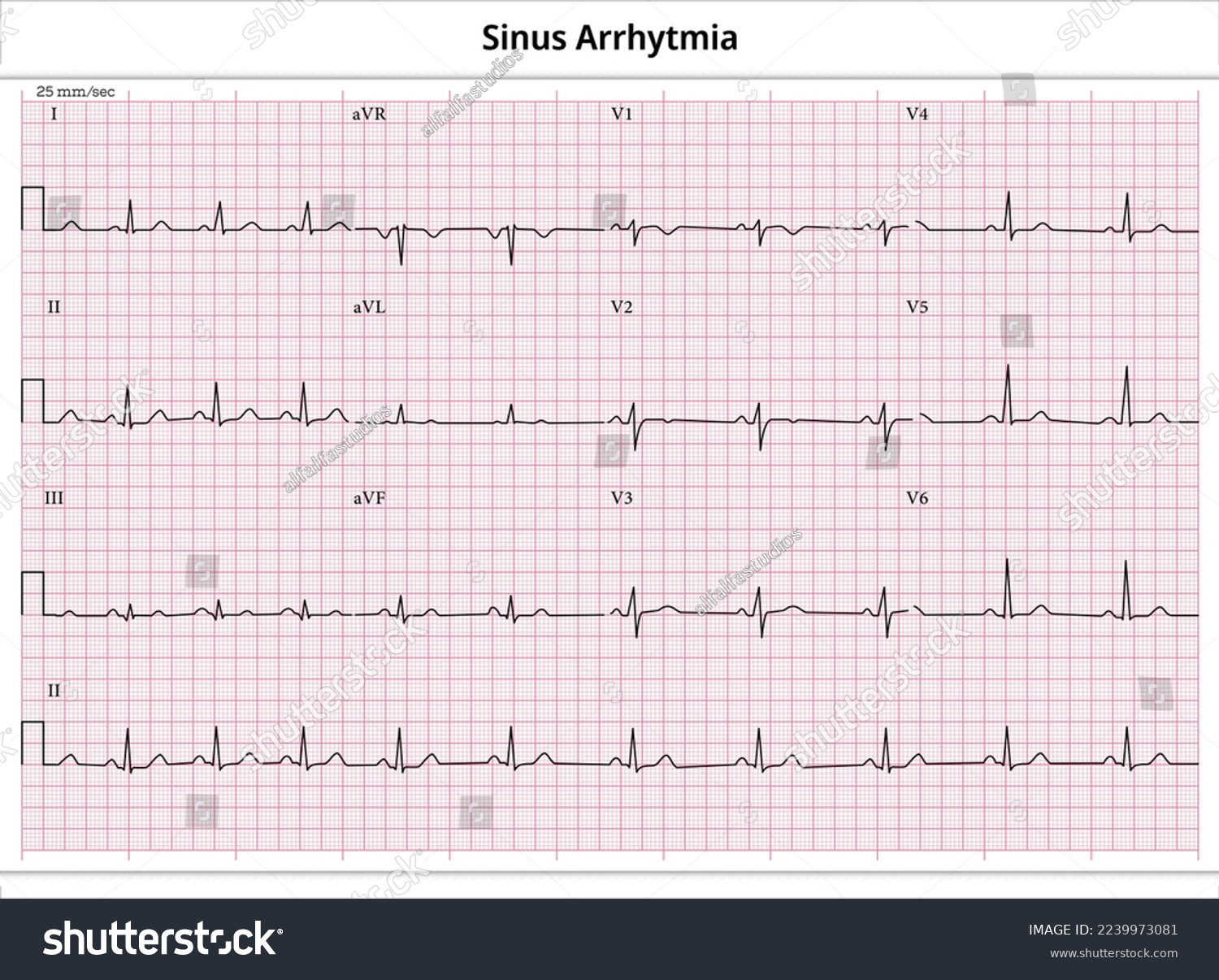 ECG Sinus Arrhytmia - 12 Leads ECG Paper - Royalty Free Stock Vector ...