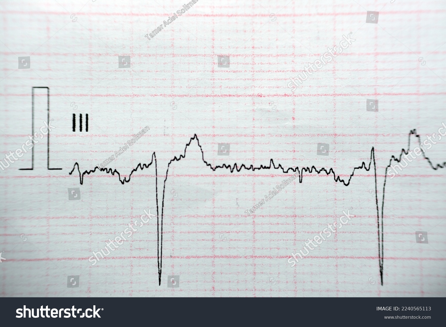 ECG ElectroCardioGraph paper that shows Normal - Royalty Free Stock ...