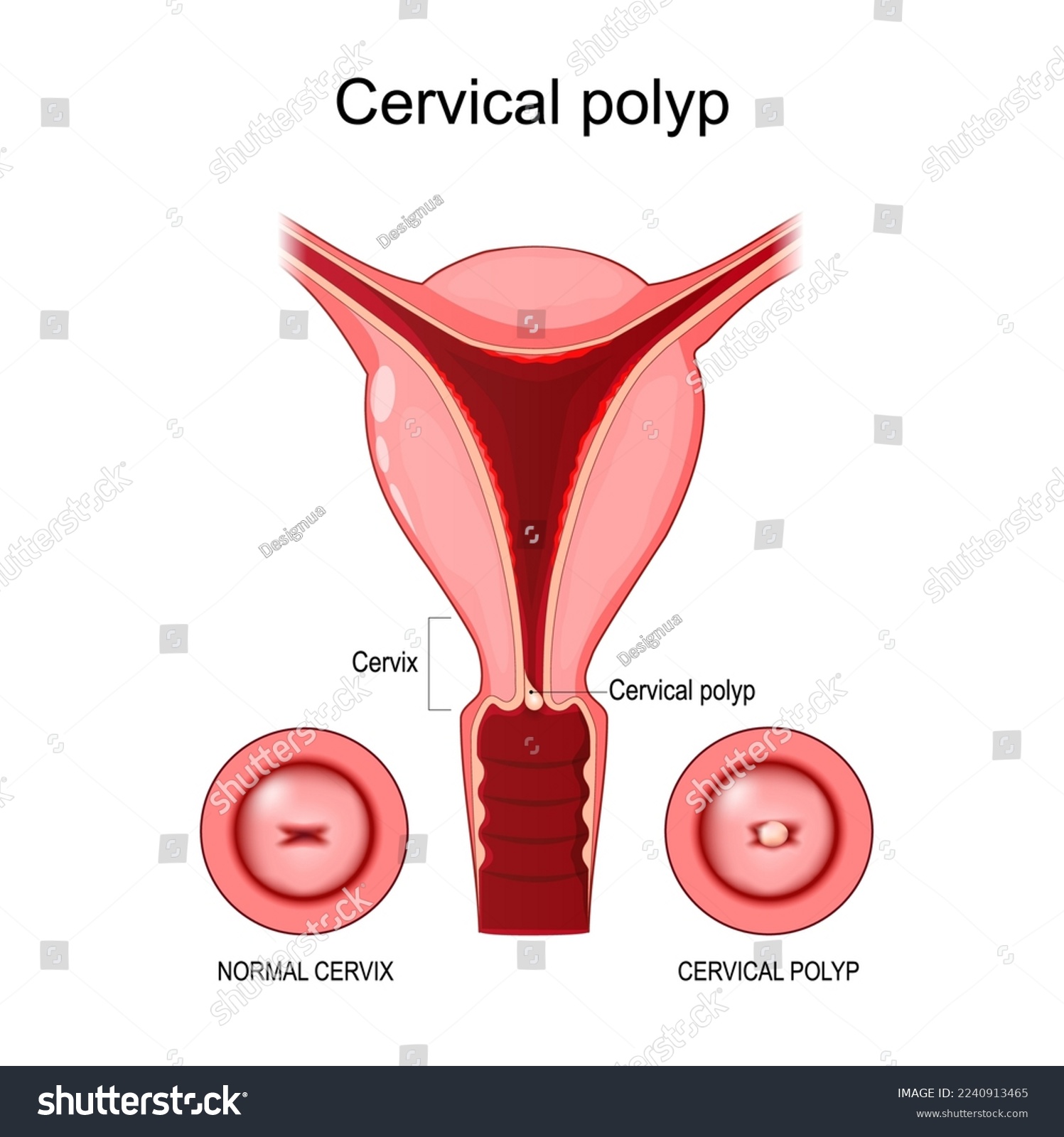 Cervical Polyp Cross Section Of A Human Uterus Royalty Free Stock