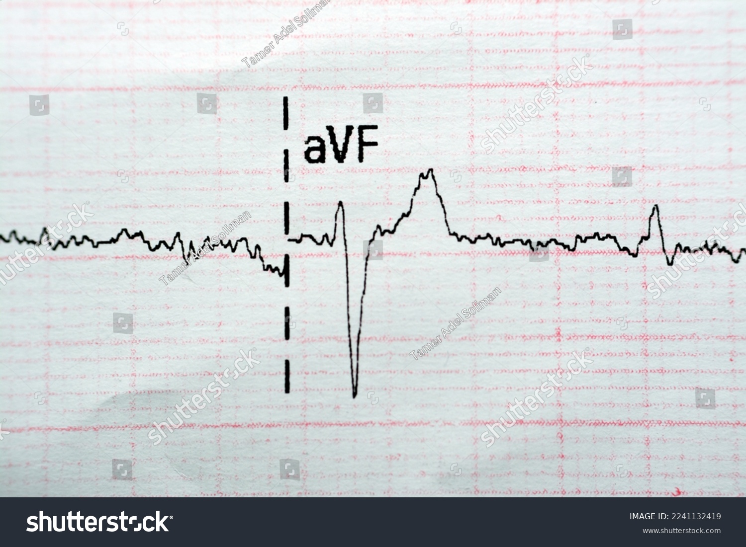 ECG ElectroCardioGraph paper that shows Normal - Royalty Free Stock ...