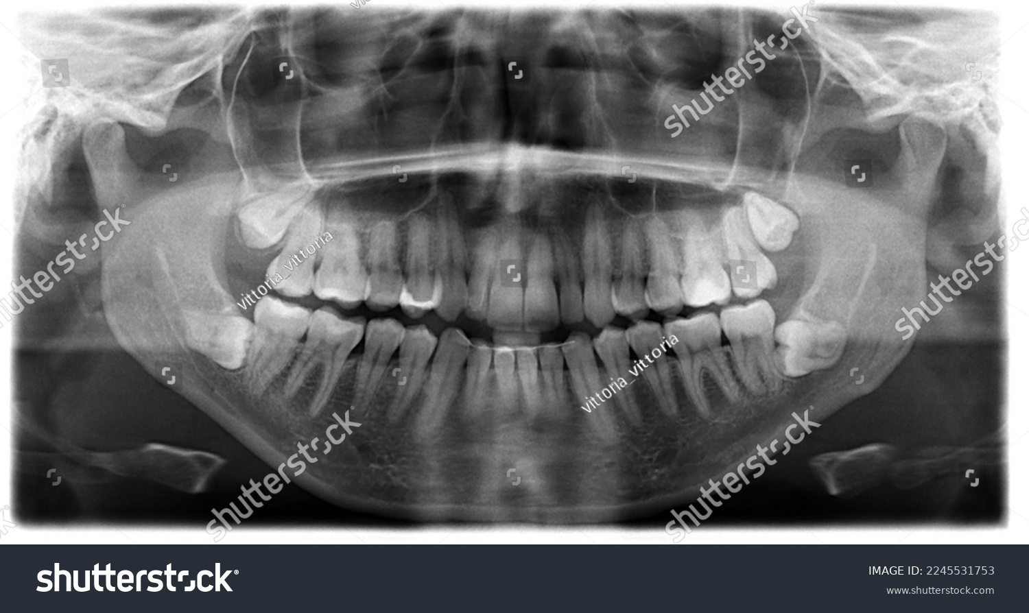 Orthopantomography, OPG X-ray DR digital wisdom teeth. panoramic film x ray dental. Noisy photo #2245531753
