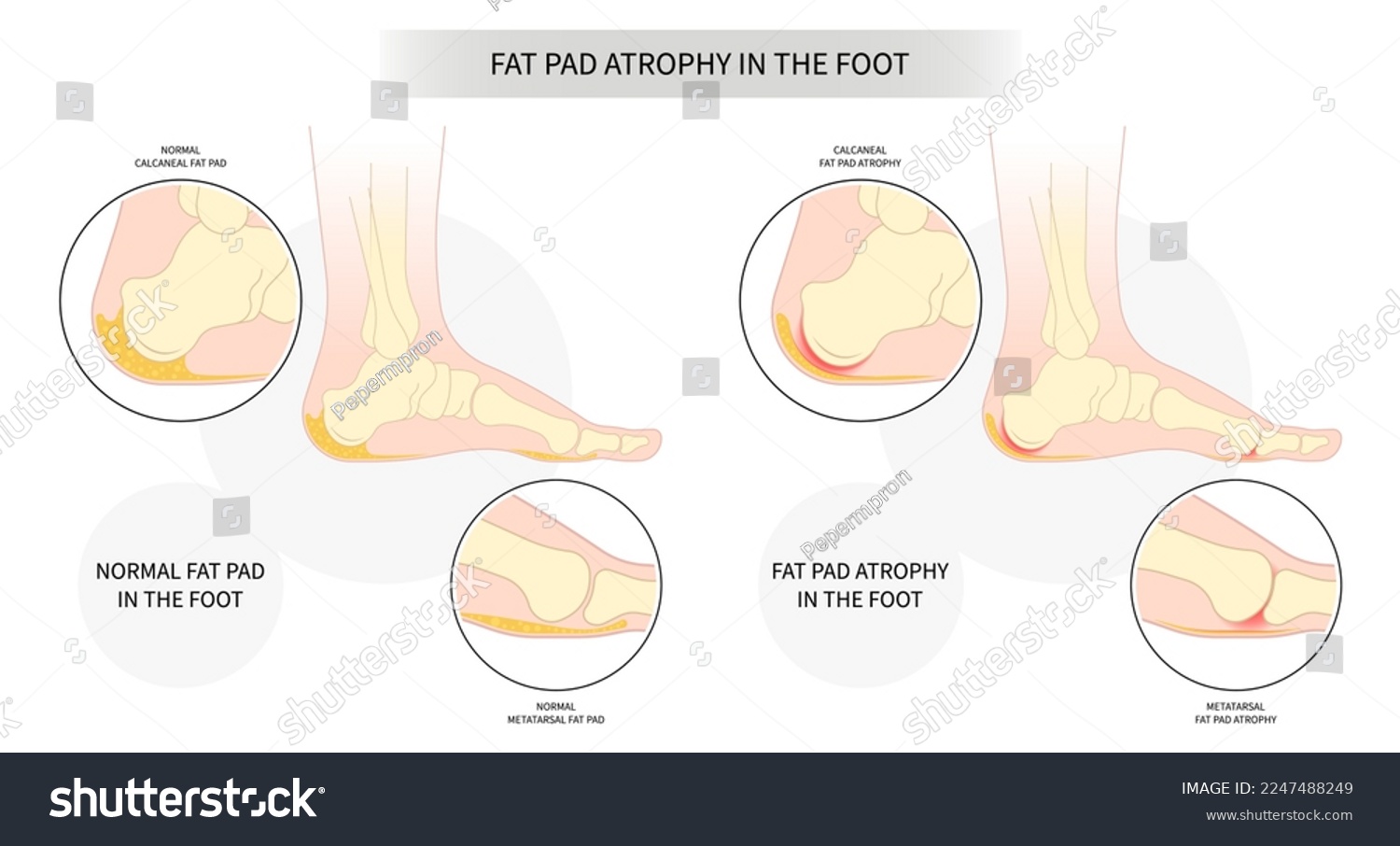 What Causes Foot Fat Pad Atrophy At Dale Armour Blog What Causes Foot Fat Pad Atrophy At Dale Armour Blog